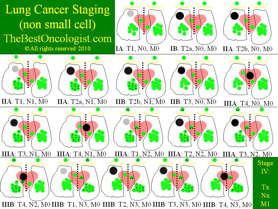 Lung Cancer Staging TNM